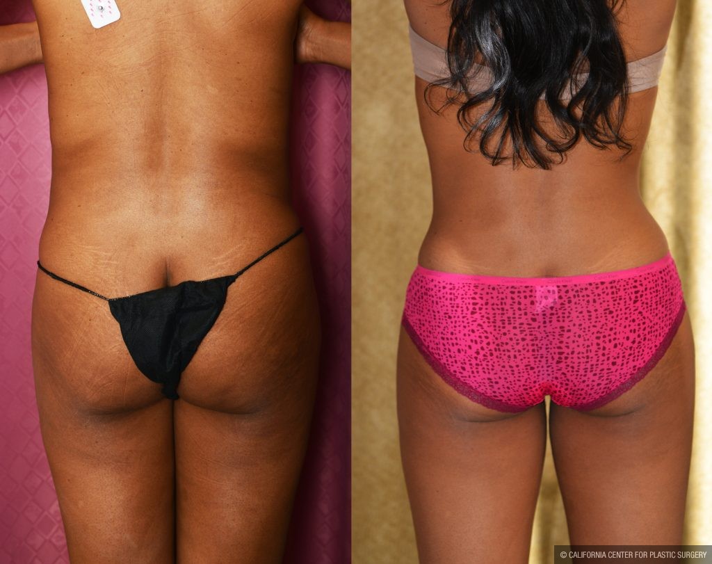 Liposuction Abdomen Medium Before & After Patient #10961