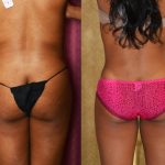 Liposuction Abdomen Medium Before & After Patient #10961