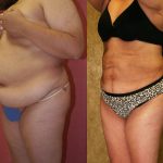 Liposuction Abdomen Plus Size Before & After Patient #10965