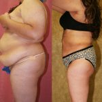 Liposuction Abdomen Plus Size Before & After Patient #10965