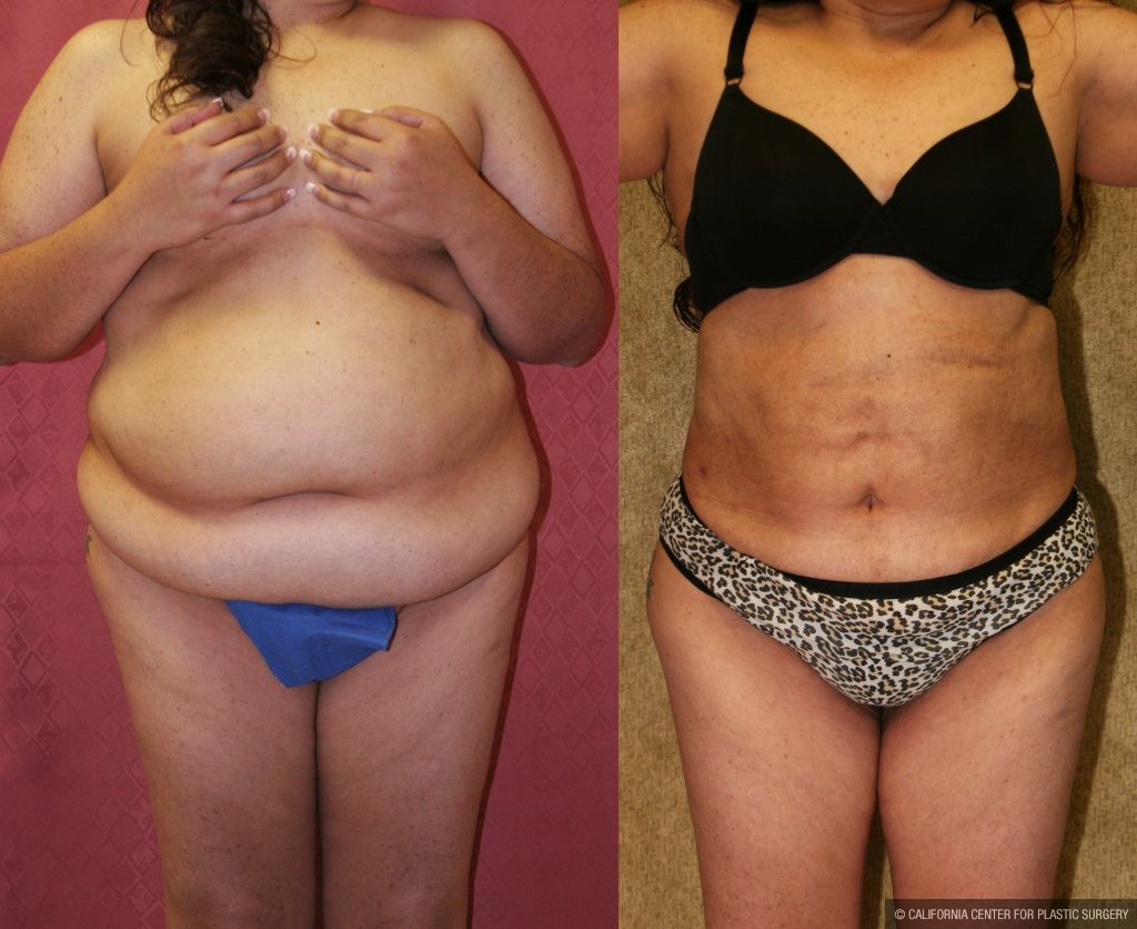 Liposuction Abdomen Plus Size Before & After Patient #10965