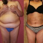 Liposuction Abdomen Plus Size Before & After Patient #10965