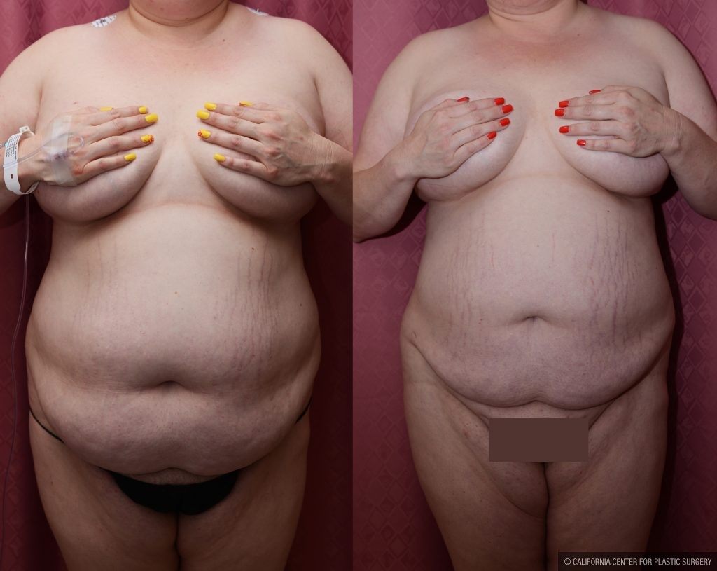 Liposuction Abdomen Plus Size Before & After Patient #10970