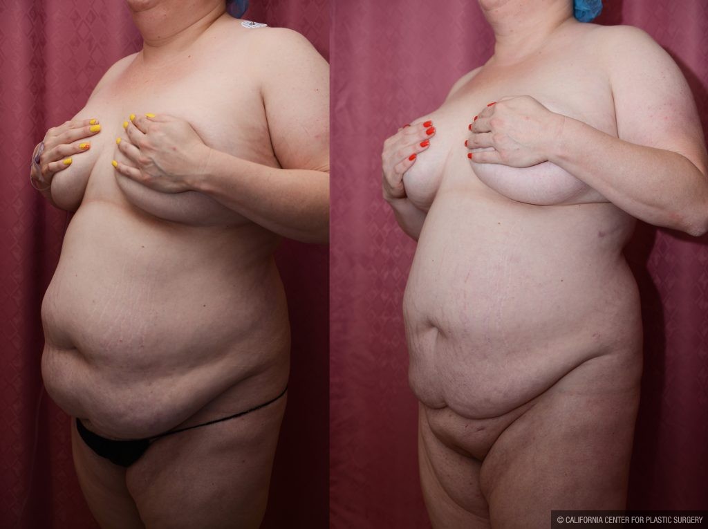 Liposuction Abdomen Plus Size Before & After Patient #10970