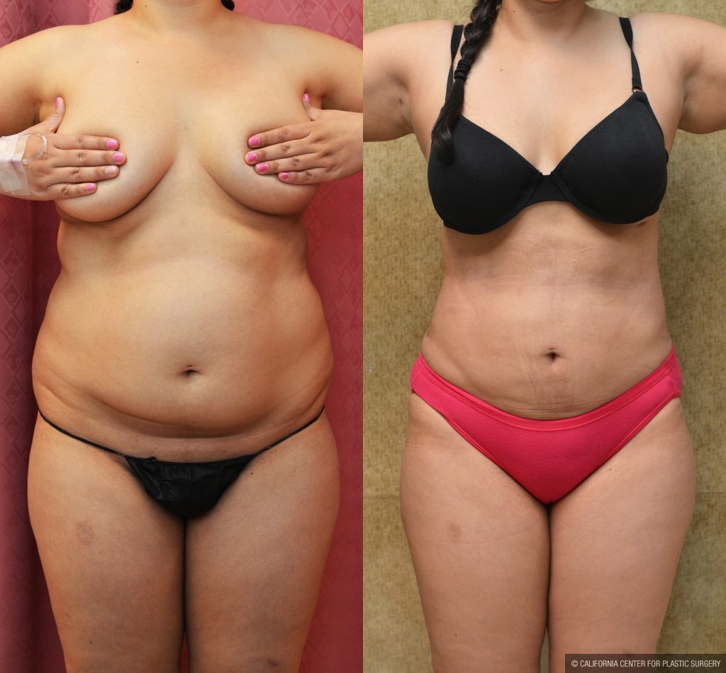 Liposuction Abdomen Medium Before & After Patient #13264