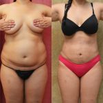 Liposuction Abdomen Plus Size Before & After Patient #10974