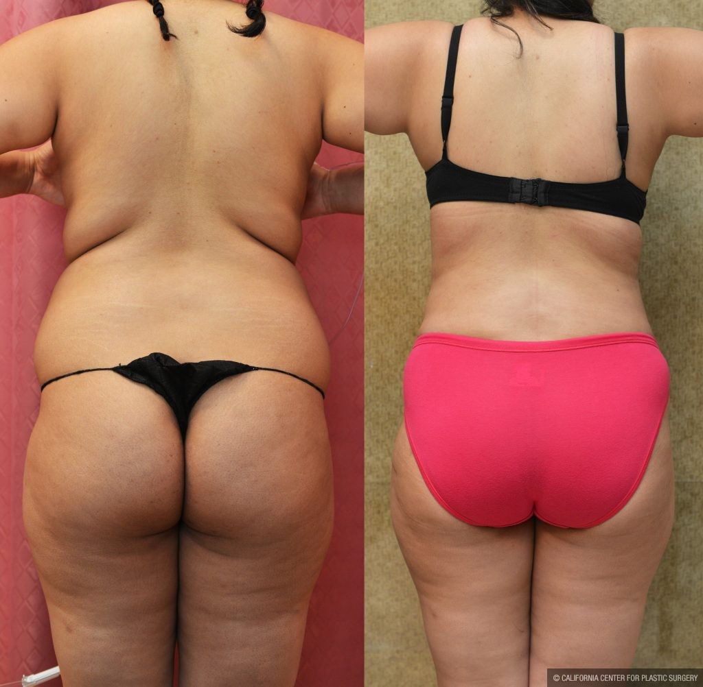 Liposuction Abdomen Medium Before & After Patient #13264