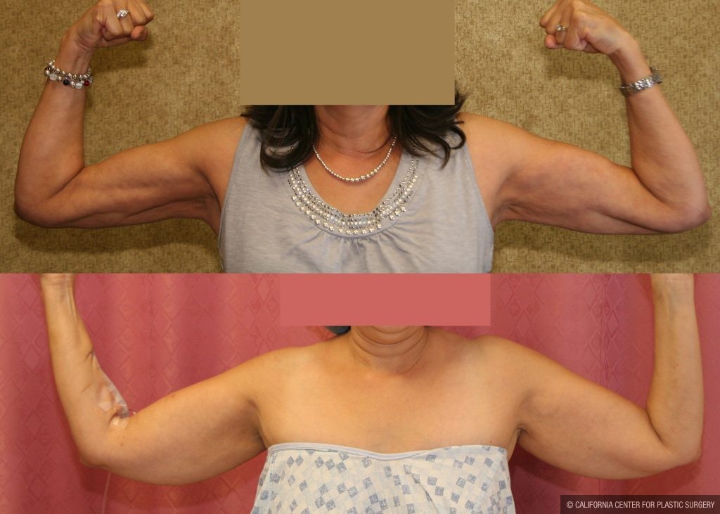 Patient #10977 Liposuction Arms Before And After Photos Beverly Hills -  Plastic Surgery Gallery Los Angeles, Ca - Dr. Sean Younai