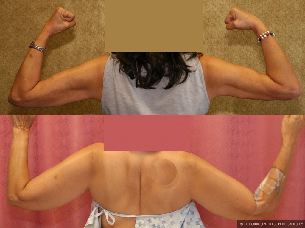 Liposuction Arms Before & After Patient #10977