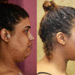 Neck & Face Liposuction Before & After Patient #10985