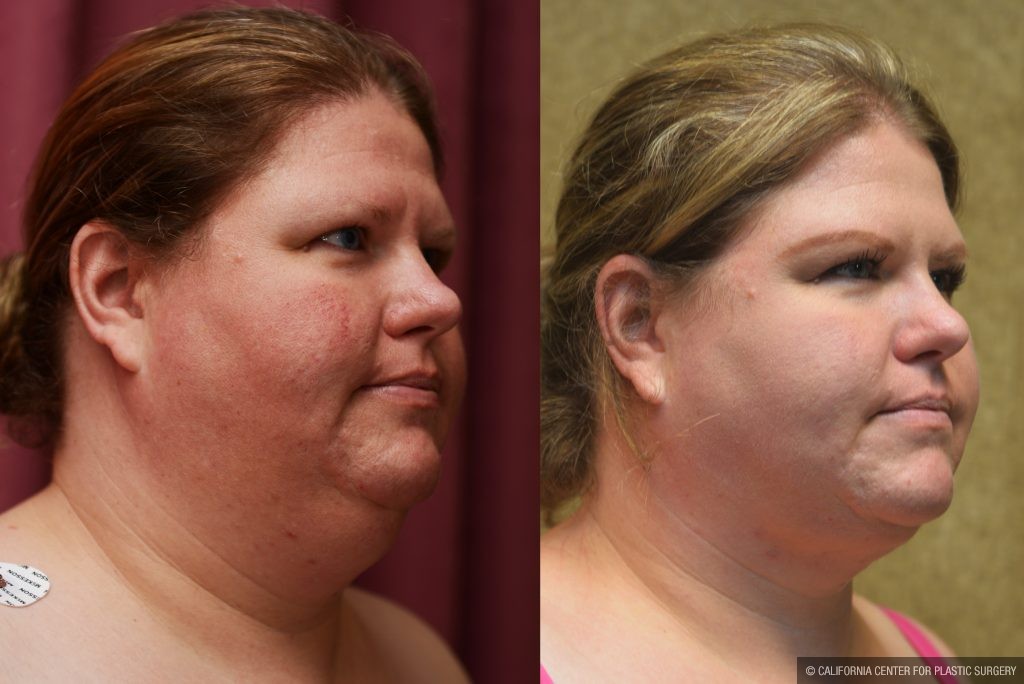 Neck & Face Liposuction Before & After Patient #10993