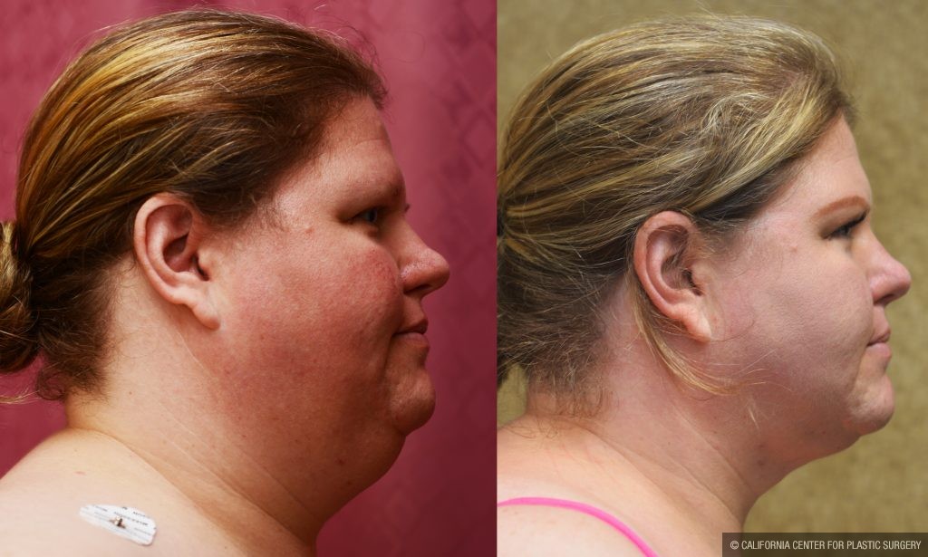 Neck & Face Liposuction Before & After Patient #10993