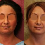 Neck & Face Liposuction Before & After Patient #10989