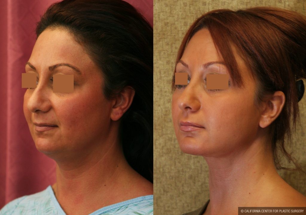 Neck & Face Liposuction Before & After Patient #10989