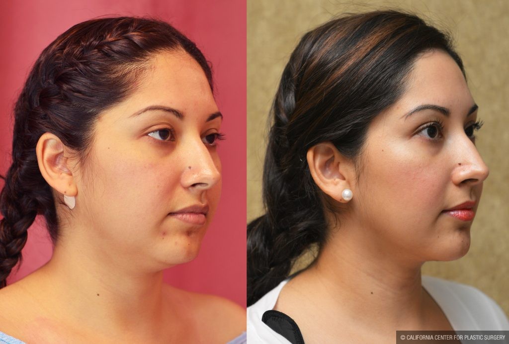 Neck & Face Liposuction Before & After Patient #11005