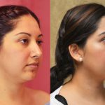 Neck & Face Liposuction Before & After Patient #11005