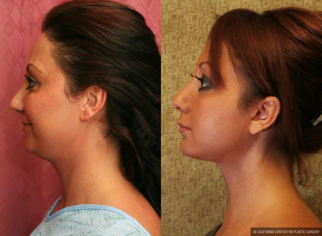 Neck & Face Liposuction Before & After Patient #10989