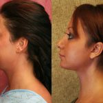 Neck & Face Liposuction Before & After Patient #10989