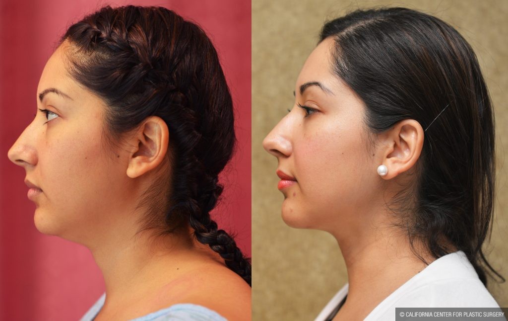 Neck & Face Liposuction Before & After Patient #11005