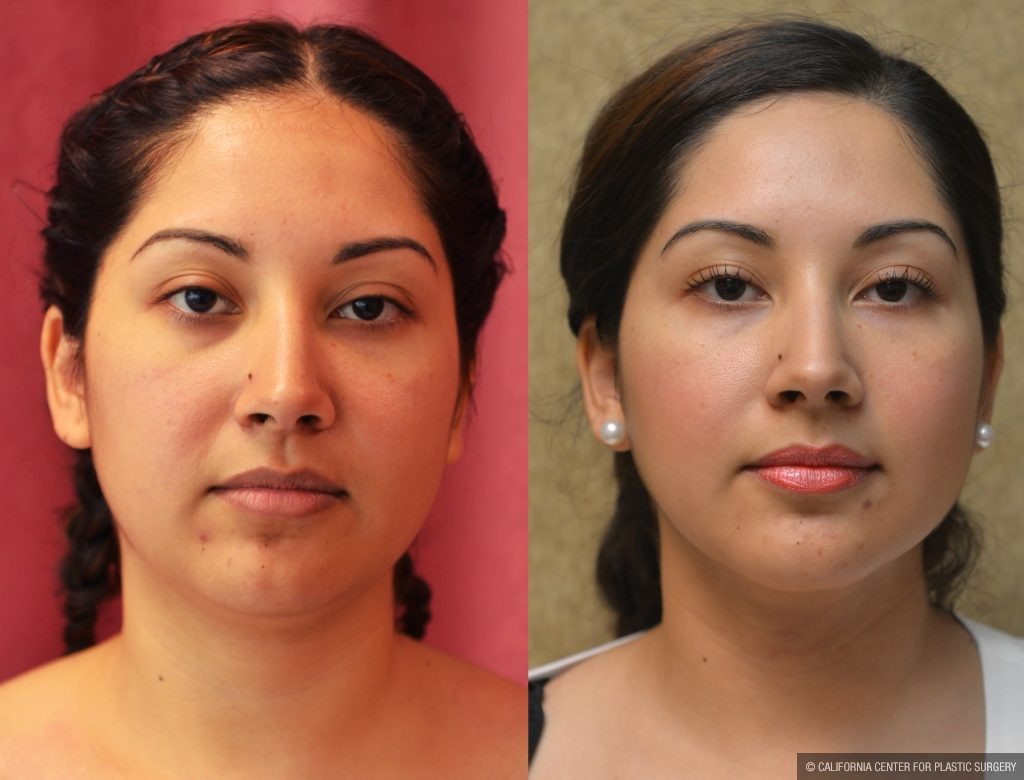 Neck & Face Liposuction Before & After Patient #11005