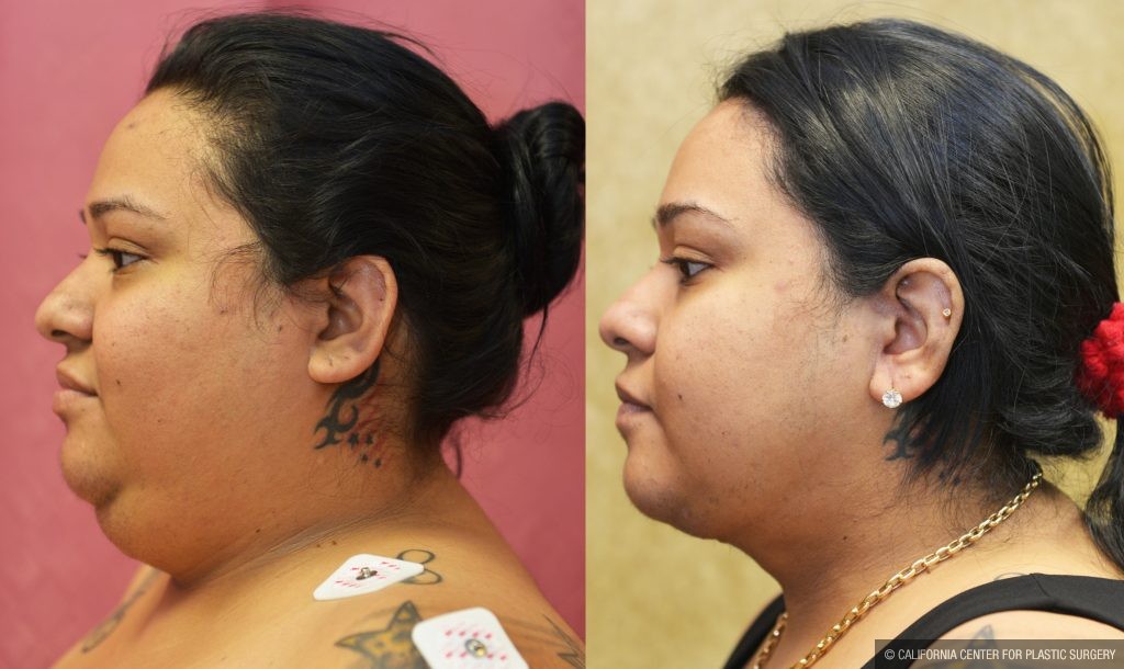 Before & After Patient #10997