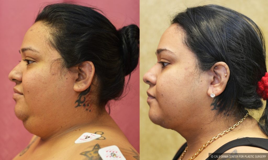 Neck & Face Liposuction Before & After Patient #13400