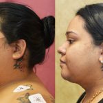 Neck & Face Liposuction Before & After Patient #13400