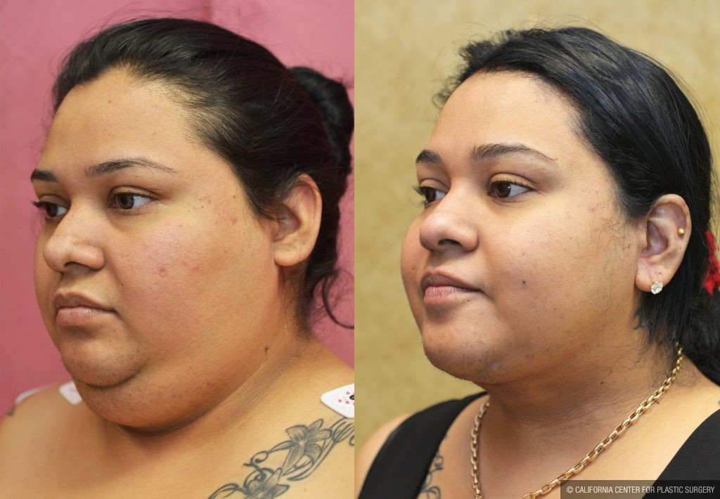 Neck & Face Liposuction Before & After Patient #13400