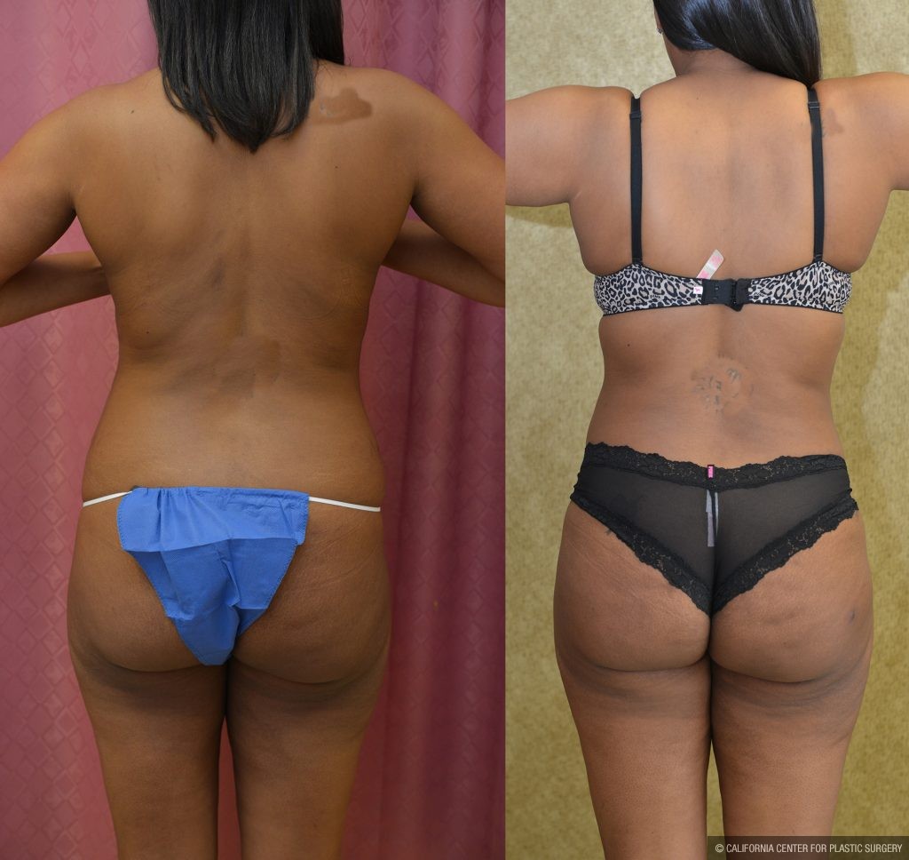 Tummy Tuck (Abdominoplasty) Medium Size Before & After Patient #11092