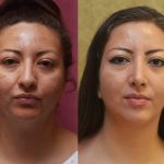 Rhinoplasty - Hispanic Before & After Patient #11020