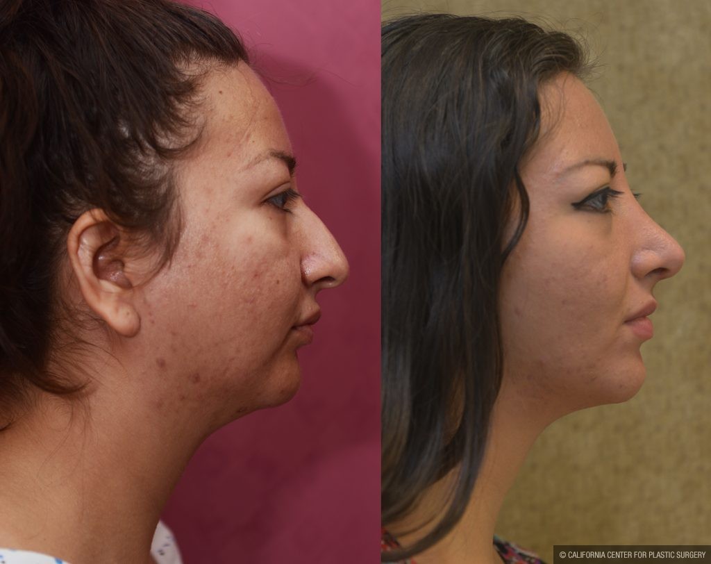 Rhinoplasty - Hispanic Before & After Patient #11020