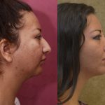 Rhinoplasty - Hispanic Before & After Patient #11020