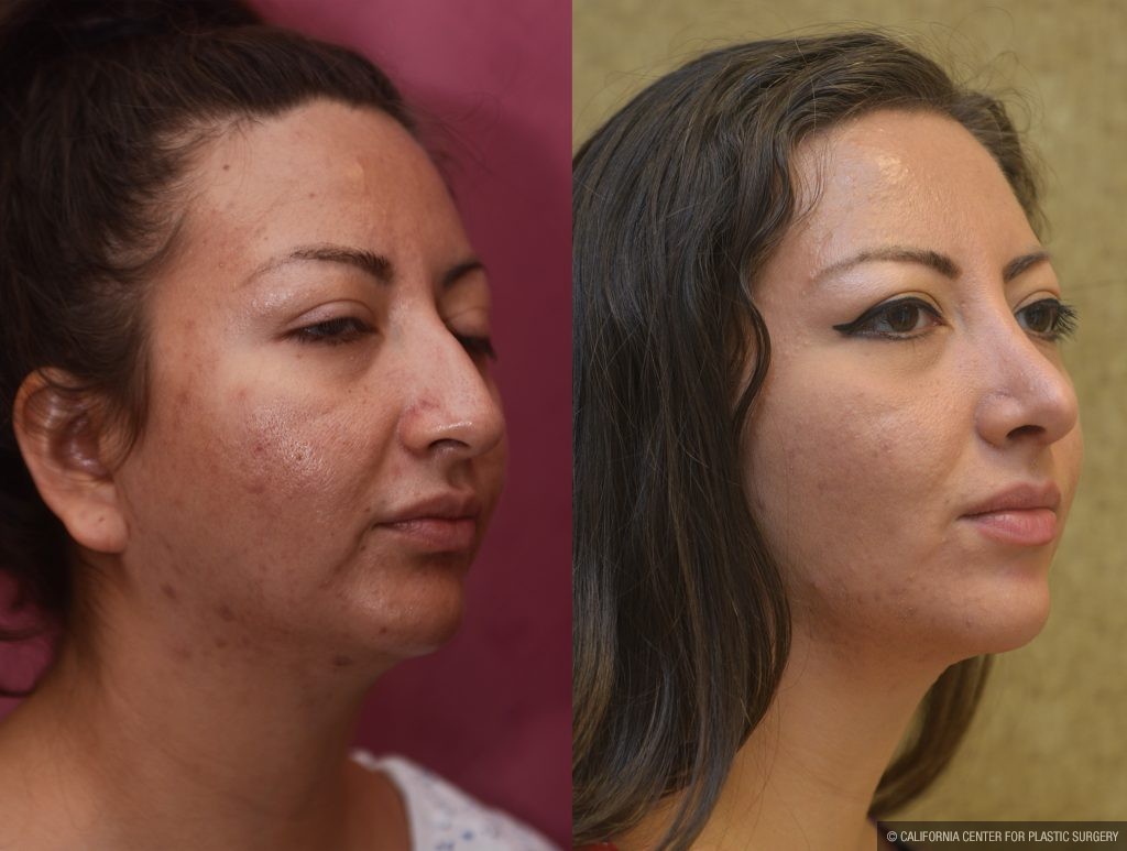 Rhinoplasty - Hispanic Before & After Patient #11020