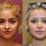 Rhinoplasty - Hispanic Before & After Patient #11013