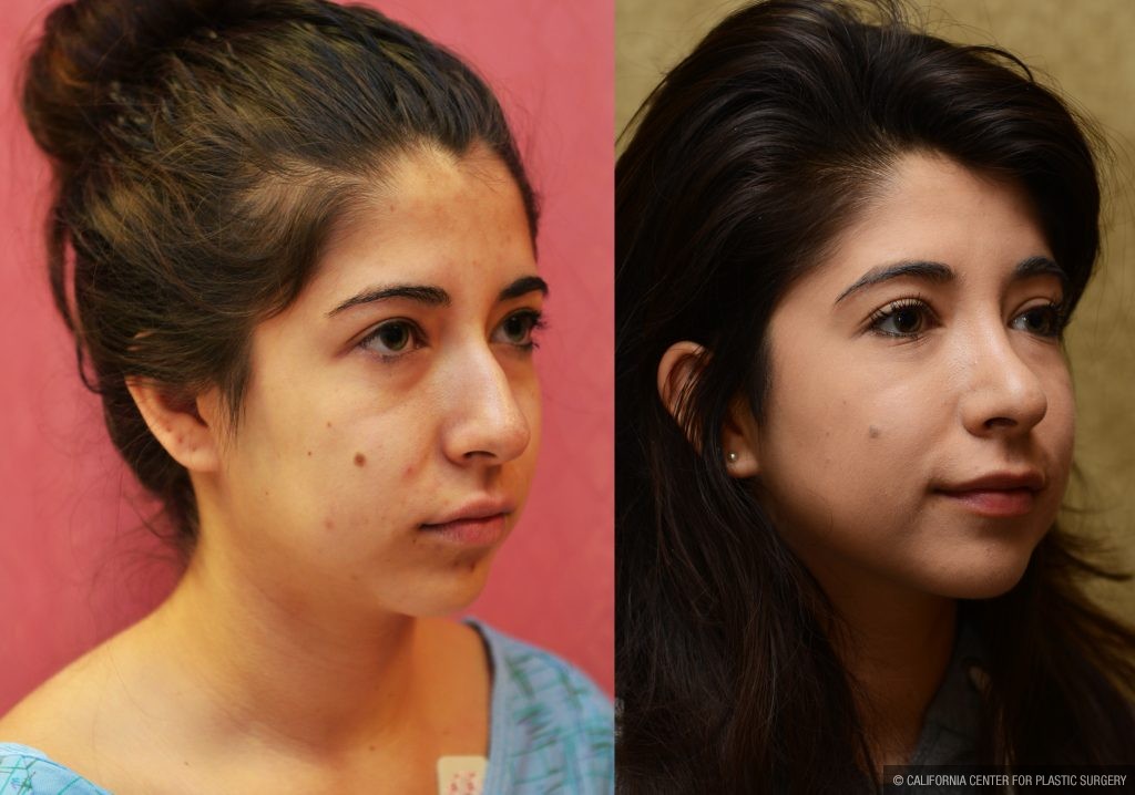 Hispanic Rhinoplasty Before & After Patient #11026