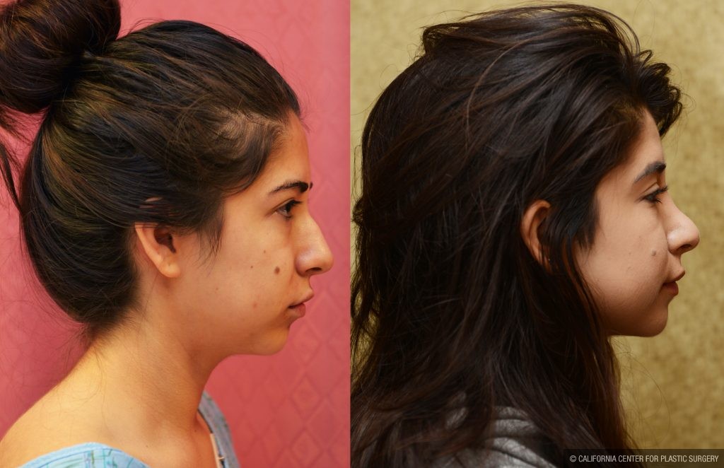 Rhinoplasty - Hispanic Before & After Patient #11026