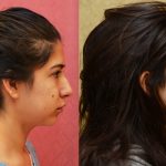 Rhinoplasty - Hispanic Before & After Patient #11026