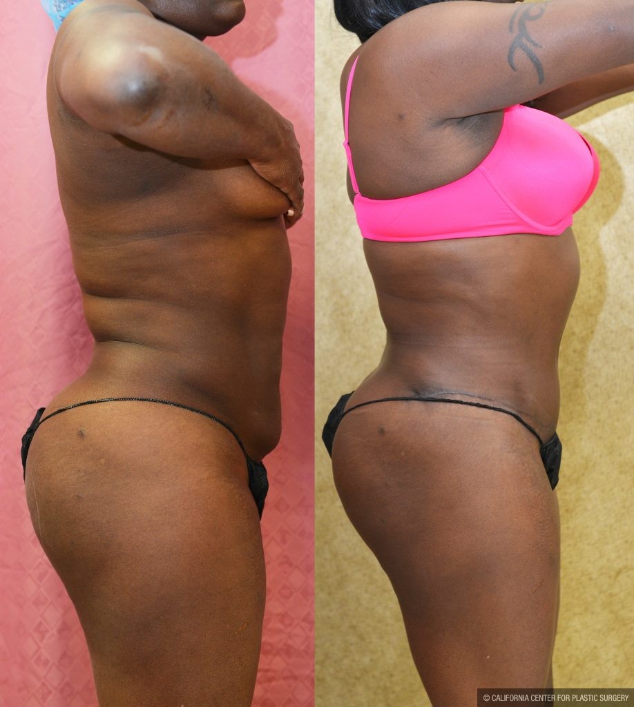 Tummy Tuck (Abdominoplasty) Small Size Before & After Patient #11033