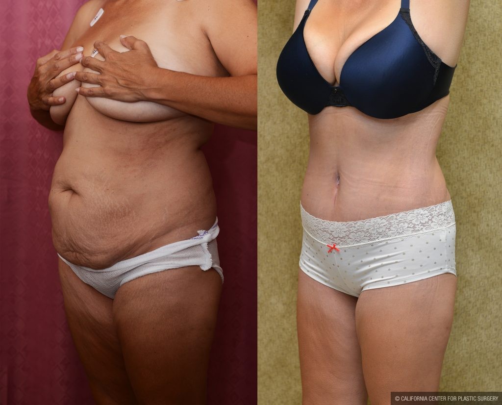 Tummy Tuck (Abdominoplasty) Medium Size Before & After Patient #11042