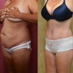 Tummy Tuck (Abdominoplasty) Medium Size Before & After Patient #11042