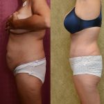 Tummy Tuck (Abdominoplasty) Medium Size Before & After Patient #11042