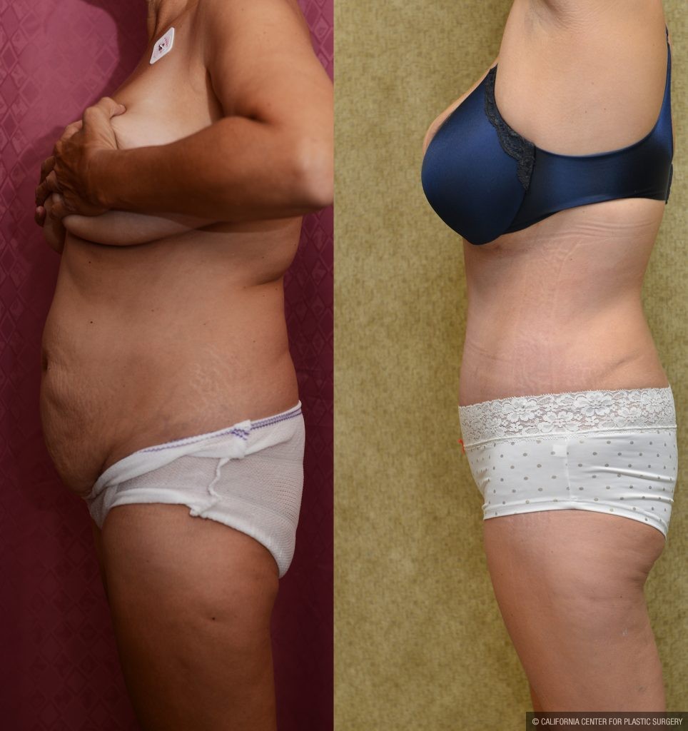 Tummy Tuck (Abdominoplasty) Medium Size Before & After Patient #11042