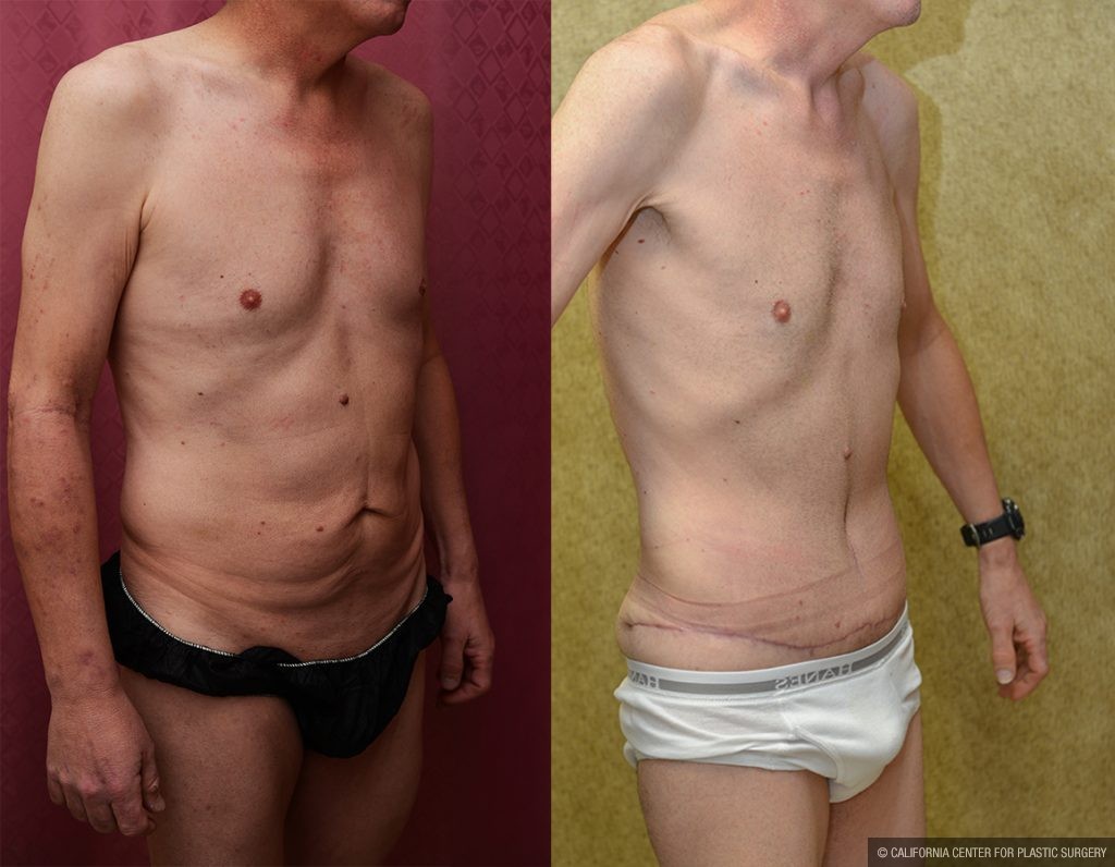 Tummy Tuck (Abdominoplasty) Small Size Before & After Patient #11075