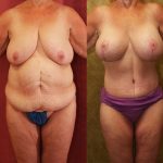 Tummy Tuck (Abdominoplasty) Medium Size Before & After Patient #11083