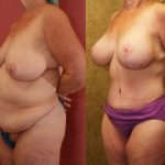 Tummy Tuck (Abdominoplasty) Medium Size Before & After Patient #11083