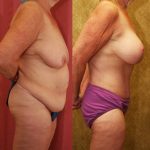 Tummy Tuck (Abdominoplasty) Medium Size Before & After Patient #11083