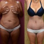 Tummy Tuck (Abdominoplasty) Scars Before & After Patient #11111