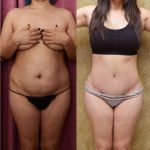 Tummy Tuck (Abdominoplasty) Scars Before & After Patient #11110
