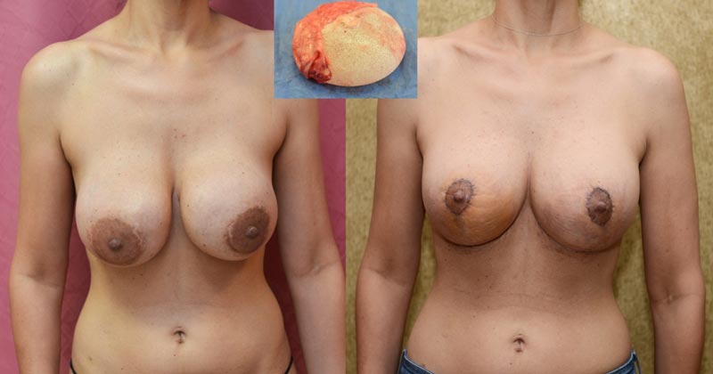 patient before and after breast revision