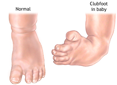 Clubfoot Correction With Implants Calf Implants Los Angeles